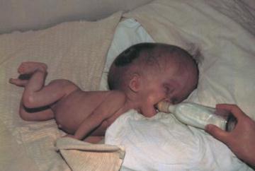 水頭症の子ども=オスパノワちゃん